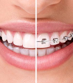 cual es mejor invisalign o brackets