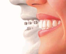 El precio de los alineadores de ortodoncia invisible ya no tiene por qué ser alto