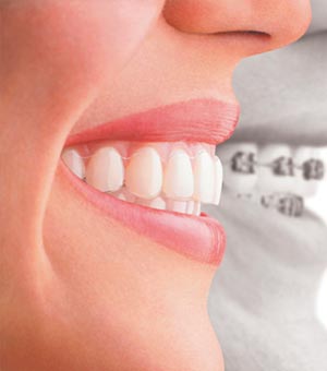 precio invisalign