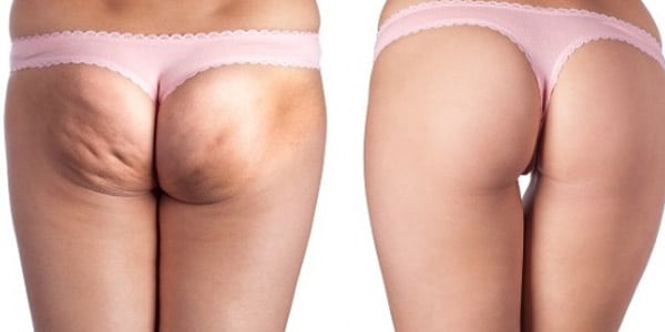 Ejercicios para acabar con la celulitis de piernas y gluteos