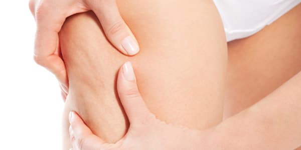 Ejercicios para la celulitis cuanto tiempo tardara eliminar la celulitis