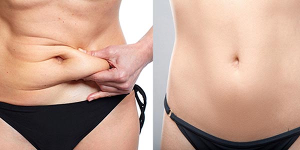 Rebajar la grasa en la zona abdominal liposucción