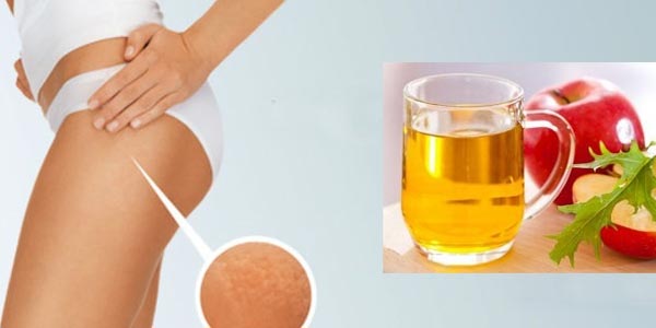 Vinagre de sidra de manzana para reducir la celulitis de los gluteos